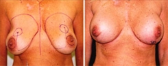 Breast Implant Revision Patient Before & After Photo 1