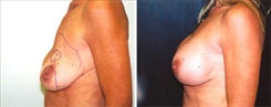 Breast Implant Revision Patient Before & After Photo 1