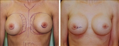 Breast Implant Revision Patient Before & After Photo 1