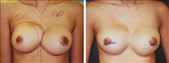 Breast Implant Revision Patient Before & After Photo 1