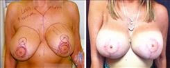 Breast Implant Revision Patient Before & After Photo 1