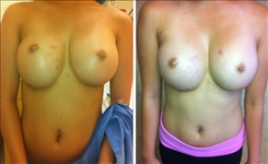 Breast Implant Revision Patient Before & After Photo 1