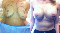 Breast Implant Revision Patient Before & After Photo 1