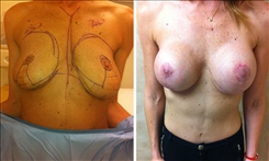 Breast Implant Revision Patient Before & After Photo 1