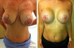 Breast Implant Revision Patient Before & After Photo 1