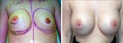 Breast Implant Revision Patient Before & After Photo 1