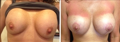 Breast Implant Revision Patient Before & After Photo 1