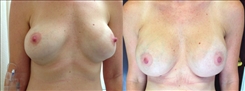 Breast Implant Revision Patient Before & After Photo 1