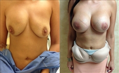 Breast Implant Revision Patient Before & After Photo 1