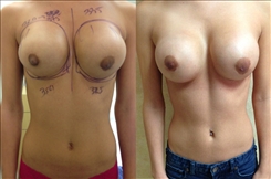 Breast Implant Revision Patient Before & After Photo 1