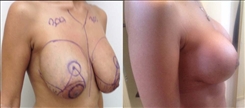 Breast Implant Revision Patient Before & After Photo 1