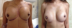 Breast Implant Revision Patient Before & After Photo 1