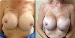 Breast Implant Revision Patient Before & After Photo 1