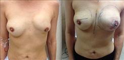 Breast Implant Revision Patient Before & After Photo 1