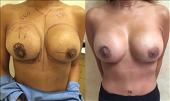 Breast Implant Revision Patient Before & After Photo 1