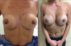 Breast Implant Revision Patient Before & After Photo 1