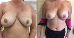 Breast Implant Revision Patient Before & After Photo 1