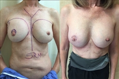 Breast Implant Revision Patient Before & After Photo 1