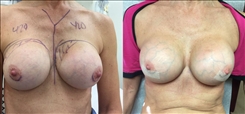 Breast Implant Revision Patient Before & After Photo 1