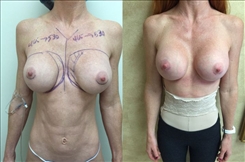 Breast Implant Revision Patient Before & After Photo 1