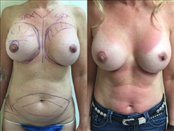 Breast Implant Revision Patient Before & After Photo 1