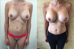 Breast Implant Revision Patient Before & After Photo 1