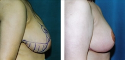 Breast Lift Patient Before & After Photo 1