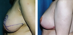 Breast Lift Patient Before & After Photo 1