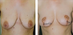 Breast Lift Patient Before & After Photo 1