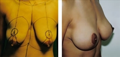 Breast Lift Patient Before & After Photo 1