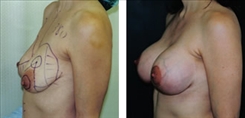 Breast Lift Patient Before & After Photo 1