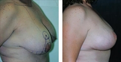 Breast Lift Patient Before & After Photo 1