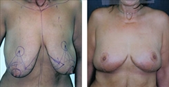 Breast Lift Patient Before & After Photo 1