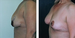 Breast Lift Patient Before & After Photo 1