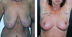 Breast Lift Patient Before & After Photo 1