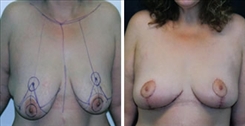 Breast Lift Patient Before & After Photo 1