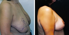 Breast Lift Patient Before & After Photo 1