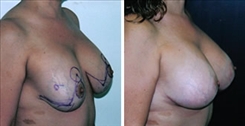 Breast Lift Patient Before & After Photo 1