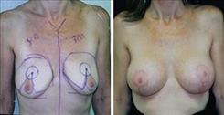 Breast Lift Patient Before & After Photo 1