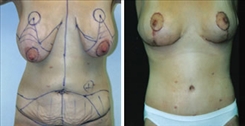 Breast Lift Patient Before & After Photo 1