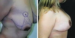 Breast Lift Patient Before & After Photo 1