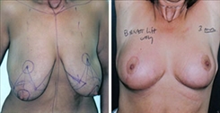 Breast Lift Patient Before & After Photo 1