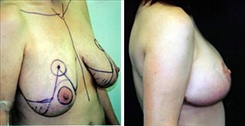 Breast Lift Patient Before & After Photo 1