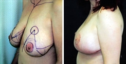 Breast Lift Patient Before & After Photo 1