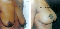 Breast Lift Patient Before & After Photo 1