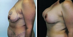 Breast Lift Patient Before & After Photo 1