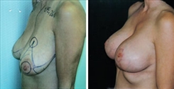 Breast Lift Patient Before & After Photo 1