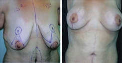 Breast Lift Patient Before & After Photo 1