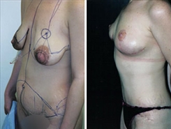 Breast Lift Patient Before & After Photo 1