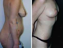 Breast Lift Patient Before & After Photo 1